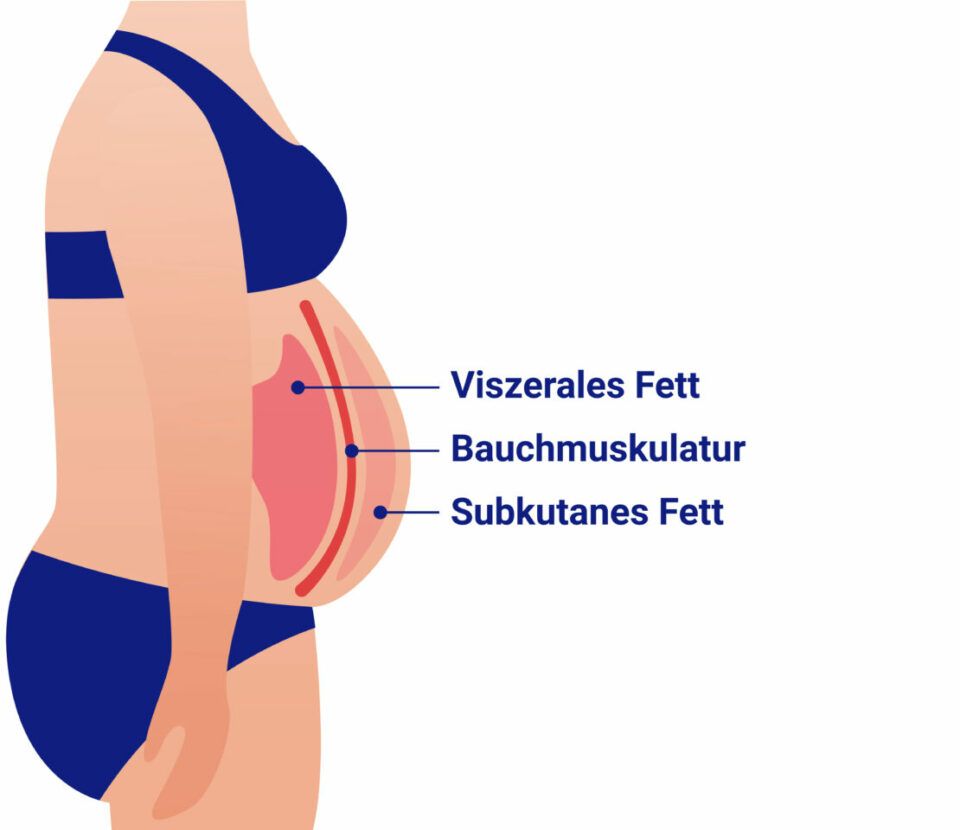 Anatomische Grafik eines Bauchs im Profil mit Beschriftung von viszeralem Fett, Bauchmuskulatur und subkutanem Fett